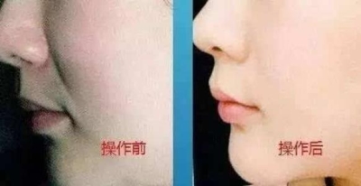 北京做的费用是多少?为什么这么受欢迎