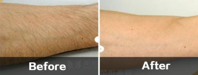 北京做激光冰点脱毛好不好?你就别“拖”着了