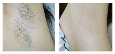 北京做激光冰点脱毛好不好?你就别“拖”着了