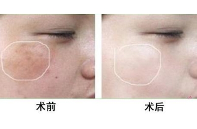北京做祛斑要花多少钱?让你能重返18岁