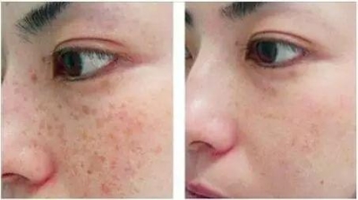 北京做祛斑要花多少钱?让你能重返18岁