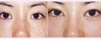 北京做祛斑要花多少钱?让你能重返18岁