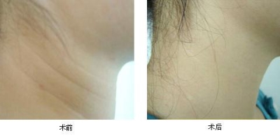 北京做电波拉皮费用