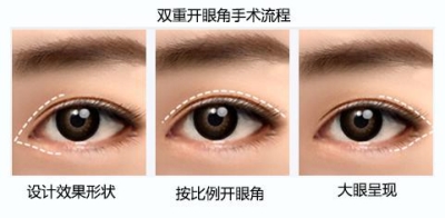 北京做开眼角医院哪家好?你,负责放电