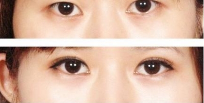 北京做开眼角需要的费用?区别就是这么大
