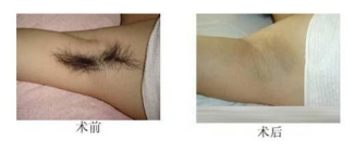 【美丽秘籍】要脱单先脱毛,春季脱毛正当时