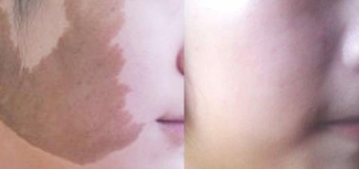 北京治疗咖啡斑效果怎么样?看详细解答