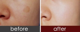 北京治疗咖啡斑效果怎么样?看详细解答