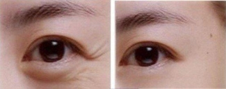 眼部除皱方法有哪些?告别眼部烦人皱纹