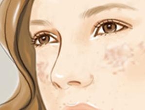 北京治疗晒斑哪家医院好?娇容再无“斑”点杂色