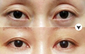 上眼皮松弛怎么解决?让你享受年轻化