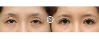 上眼皮松弛怎么解决?让你享受年轻化