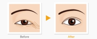 上眼皮松弛怎么解决?让你享受年轻化