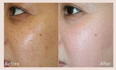 如何去眼袋周围黑色素?黑色素沉淀怎么办