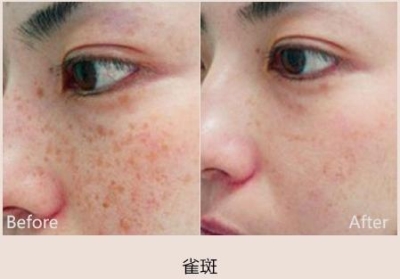 如何去眼袋周围黑色素?黑色素沉淀怎么办